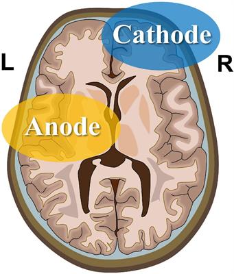 Modulation of thalamic network connectivity using transcranial direct current stimulation based on resting-state functional magnetic resonance imaging to improve hypoxia-induced cognitive impairments